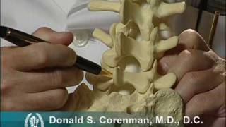 Isthmic Spondylolisthesis Video  Stress Fracture of the Back Vertebra  Spine Surgeon Colorado [upl. by Aicenert]