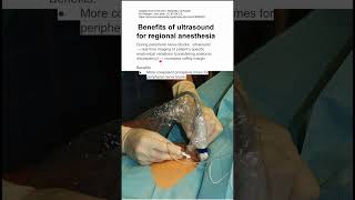 Benefits of ultrasound for regional anesthesia [upl. by Acinna968]