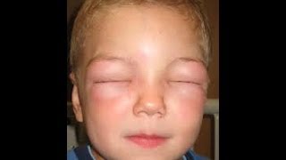 Anaphylaxis due to Drug allergy [upl. by Bertle772]