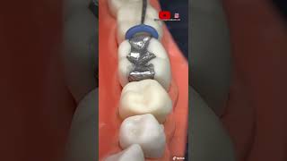 ¡🔥Instalación de separadores dentales y bandas metálicas en las muelas 0🦷0🔥 [upl. by Sawtelle]