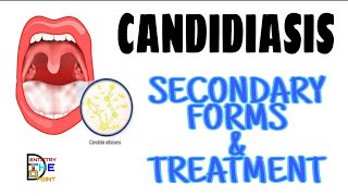 CANDIDIASIS  SECONDARY ORAL CANDIDIASIS  HISTOLOGICAL FEATURES amp TREATMENT [upl. by Nodnyl]