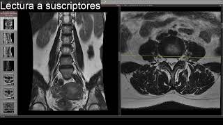 Interpretando una resonancia lumbar  Dolor lumbar [upl. by Alboran]