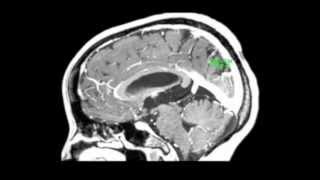 Endoscopic treatment of a third ventricle choroid plexus cyst [upl. by Latyrc]