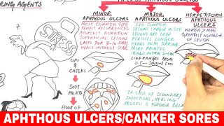 Aphthous Ulcers  Canker Sores  Pathophysiology Triggers Types amp Treatment [upl. by Boycey439]