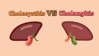 Difference between Cholangitis and Cholecytitis [upl. by Adnor363]