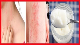 Saiba Como EVITAR Alergias na Pele Por Causa do Calor  Creme Caseiro que Acaba Com ALERGIAS [upl. by Jed890]