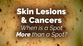 When is a Spot More than a Spot Skin Lesions and Cancers [upl. by Werda]