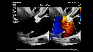 Ostium secundum ASD Echocardiography [upl. by Fachini]