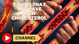 7 Signs That You Have High Cholesterol [upl. by Eiramait782]