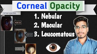 Corneal Opacity  The Cornea  MKSharma Ophthalmic Education Ophthalmology [upl. by Rodina682]