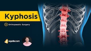 Kyphosis  Orthopedic Surgery Lectures  Medical Online Education  VLearning  sqadiacom [upl. by Sarid823]