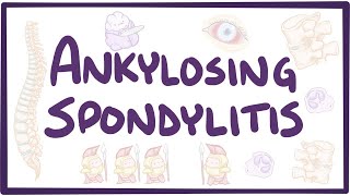 Ankylosing spondylitis  causes symptoms diagnosis treatment pathology [upl. by Xavler416]