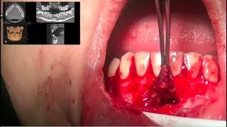 Radicular Cyst Enucleation [upl. by Jared826]