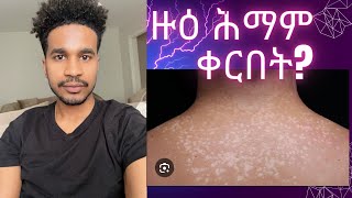 ሕማም ቀርበት pityriasis versicolor [upl. by Genie]