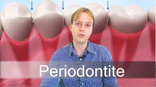 Periodontite [upl. by Bron]