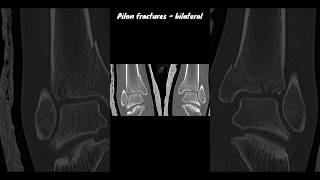 Pilon fractures  bilateral ctankle [upl. by Harmon]