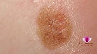 Melanoma Pictures  Signs Symptoms Causes Photos Images Pictures of Melanoma Skin Cancer [upl. by Nytram]