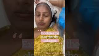 Underarm lightening peel  DermaZeal Clinic  Bangalore chemicalpeel shorts dermatologyclinic [upl. by Atikam500]