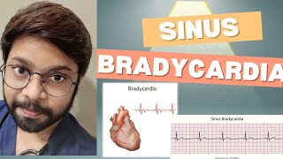 Sinus Bradycardia [upl. by Oruasi]