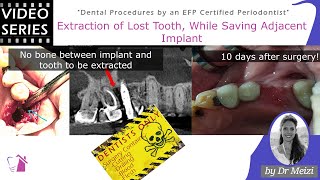 Extraction of Lost Tooth While Saving Adjacent Implant [upl. by Atiral751]