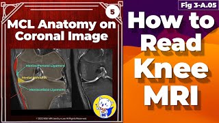 Fig 3A05 Medial Collateral Ligament Anatomy Knee MRI coronal and axial images [upl. by Zingg]