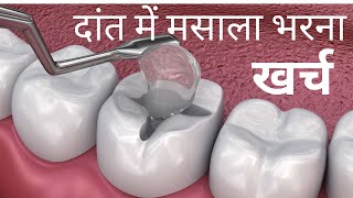 दांतों की कैविटी में मसाला भरना खर्च Dat me Hole dant me kide ka ilaj Dental filling amp Cost [upl. by Husch484]