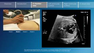 Key screening views of the fetal heart  Part 3  4chamber view [upl. by Kinnard]