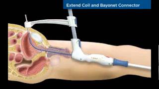 SwanT SPeC Transurethral Suprapubic Cystostomy YouTube [upl. by Bekha]