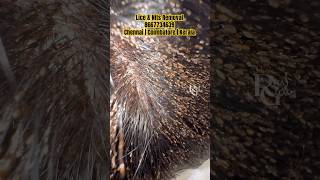 How to remove nits from hairlice removallice removal Treatment in Parlourhow to prevent lice [upl. by Atival]