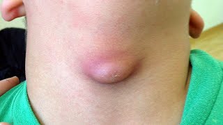 Inflamed Thyroglossal Cyst [upl. by Ahsemrak652]