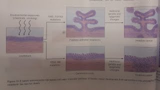 Urothelial Transitional Cell Carcinoma  SPECIAL PATHOLOGY [upl. by Wendelina]