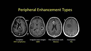 imaging of Multiple sclerosis [upl. by Anegal]