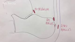 Injection  pre Achilles bursitis CSI injection another patient [upl. by Annatnas385]