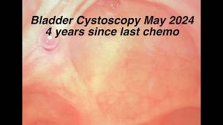 Bladder Cystoscopy 4 Years after Chemo Ended May 2024 [upl. by Brote]