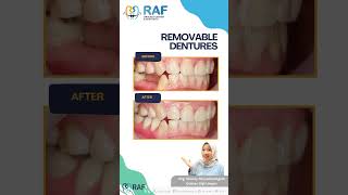 Removable dentures valplast gigitiruan dentist [upl. by Merrielle]