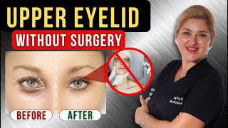 Upper eyelid filler injection Upper eyelid lift without surgery [upl. by Moersch]