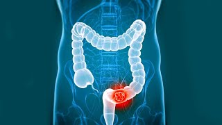 colon cancer  colorectal cancer  colon and rectal cancer [upl. by Mail]