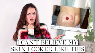 How I Healed the Skin Around My Stoma  Lets Talk IBD [upl. by Lorenza18]