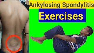 Ankylosing spondylitis Stretches Exercises ampDiet [upl. by Vernon610]