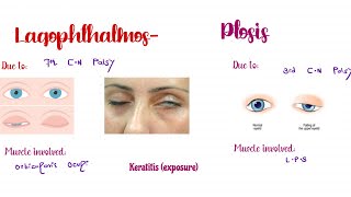 Lagophthalmos and PtosisWhat is the difference between them Ophthalmology [upl. by Cassy773]