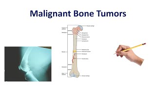 Malignant Bone Tumors  USMLE COMLEX NCLEX [upl. by Ehtyde]