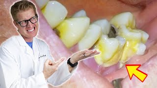 Patients Tooth FALLS OUT During Deep Cleaning TONS OF PLAQUE TARTAR amp GROSS Bacteria Removed [upl. by Adlee]