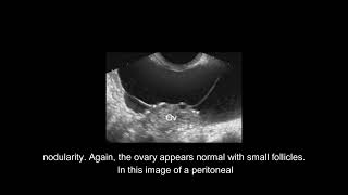 Sonographic Evaluation of The Ovary and Adnexa [upl. by Oberg]