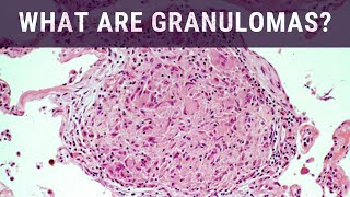 What are Granulomas  Pathology mini tutorial [upl. by Arly]