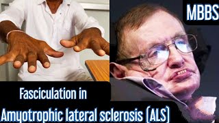 Fasciculation in Amyotrophic lateral sclerosis ALS mbbs medicine neet usmle aiims next [upl. by Ihsorih]