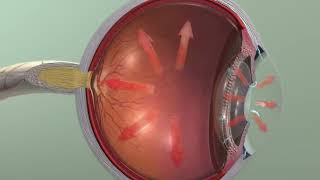 Animation Glaucoma [upl. by Annalla]