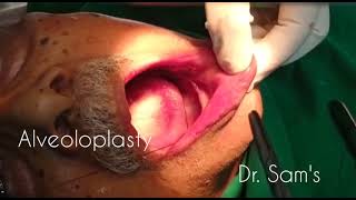 Alveoloplasty Surgery  Ridge remodelling for Denture Placement [upl. by Dlonyer]