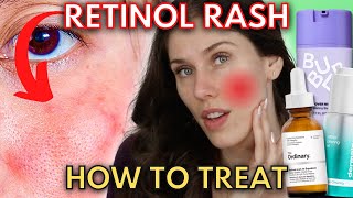 Do You Have A Retinol Rash Or Are You Experiencing Retinization [upl. by Nomled408]