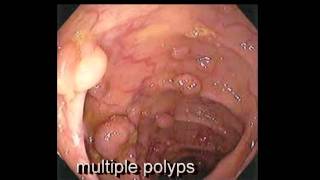 Colonoscopy FollowUp of Colon Polyp  Los Angeles Colonoscopy [upl. by Arita90]