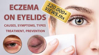 Eczema on Eyelids 2022  2023  Causes Symptoms Types Treatment and Prevention [upl. by Thrift949]